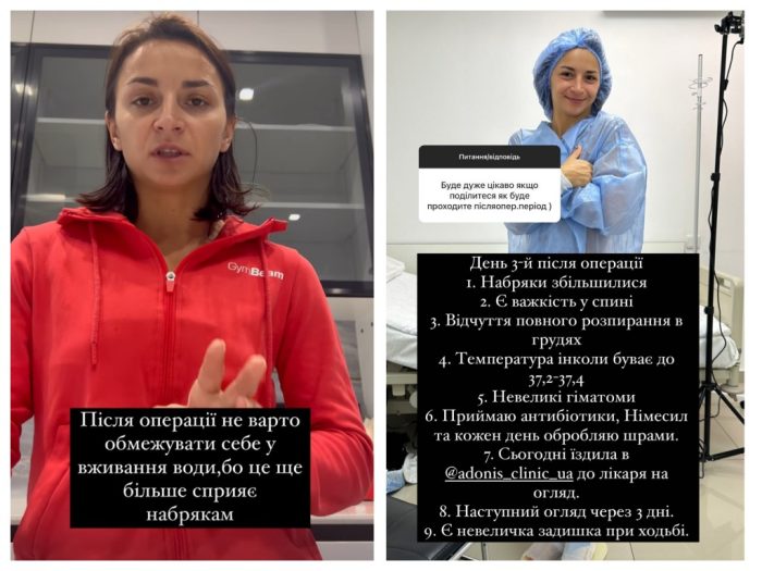 Ілона Гвоздьова про перші враження після маммопластики та поради лікарів